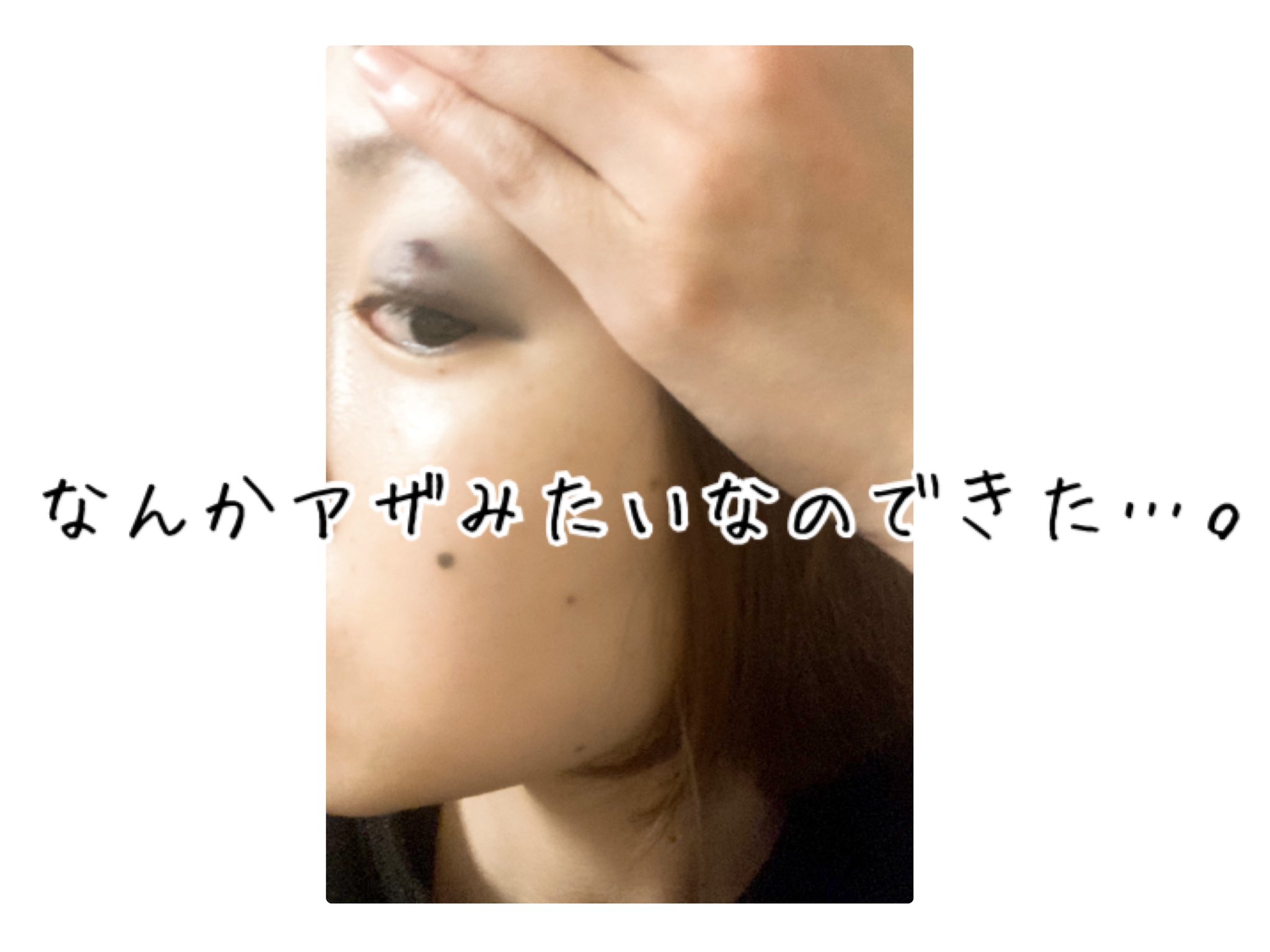 のりこ いるかのせなか 昨日のまぶたの青あざの原因は 昨夜飲んだ頭痛薬 バファリン の副作用の可能性が大きいとみてますw 頭痛は治ったので 半分優しさの代わりに 半分青あざにして下さったようです ありがとうございます ほかの