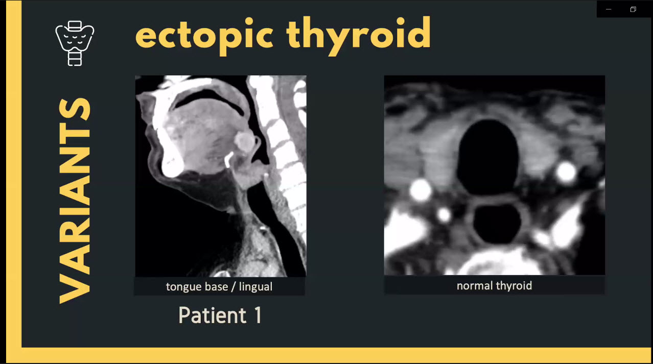 ASHNR on X: &ldquo;#HNxHN In setting of ectopic thyroid, imp to look for 