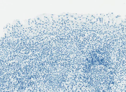 RocheDiaUSA's tweet photo. You are looking at a cervical punch biopsy specimen stained with CINtec Histology.
The p16 staining pattern in this view is characterized as …?
1. Diffuse staining
2. Focal staining
3. Background staining
4. I don’t know
#tweetorialtuesday #IHCPath #cervicalcancer #RocheMSA https://t.co/tkW3trOPhz
