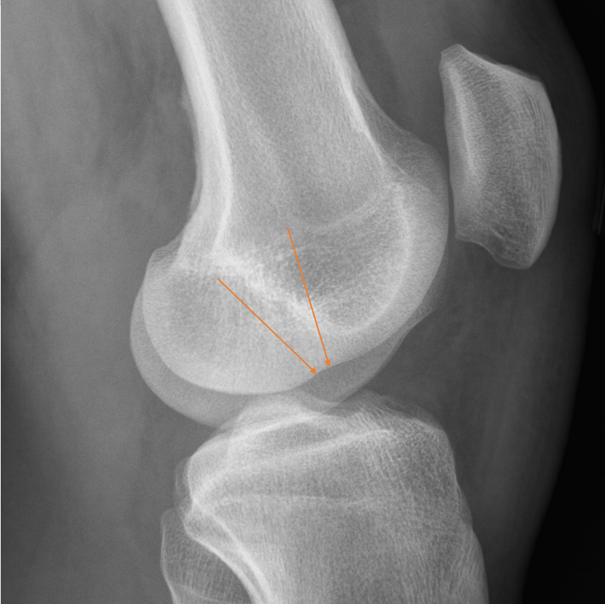 CtSpectral's tweet photo. Lateral femoral notch sign: A reliable indicator of ACL tear on XR. 
#FOAMed #radres
https://t.co/snNntgn7FW https://t.co/OHrvDPXdXj