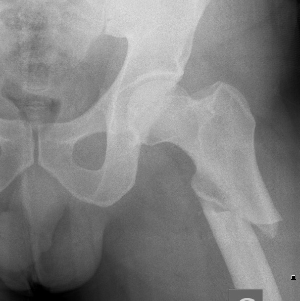 Comme pour ce saignement intracrânien. Tout le monde le voit ! Mais qui se mouillera sur la cause (MAV) ? Et cette fracture fémorale évidente : pour un spécialiste comme moi elle est sûrement liée à une prise de bisphosphonates, non? Mais ce ne sera jamais écrit sur l'image (4/x)