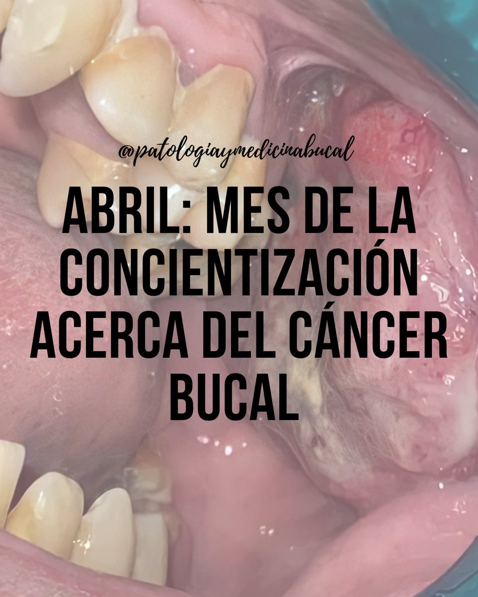 patoymedbucal's tweet photo. Abril: mes de la concientización acerca del cáncer bucal.
#PatologiaBucal #PatoaBucal #MedicinaBucal #MedBucal #OralPathology #OralMedicine #CancerBucal https://t.co/ofcZ5Xg4h3