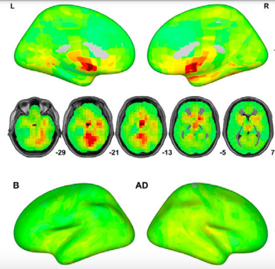 PTenigma's tweet photo. 85,721 MRI scans from 50,876 people (!) used to create deep learning method to detect Alzheimer's disease. In a quite large study, Bin Lu, @ycgyan + team apply transfer learning to brain scans from >217 sites/scanners  https://t.co/aYEZ9sZuCT https://t.co/DxneQ6dMq9