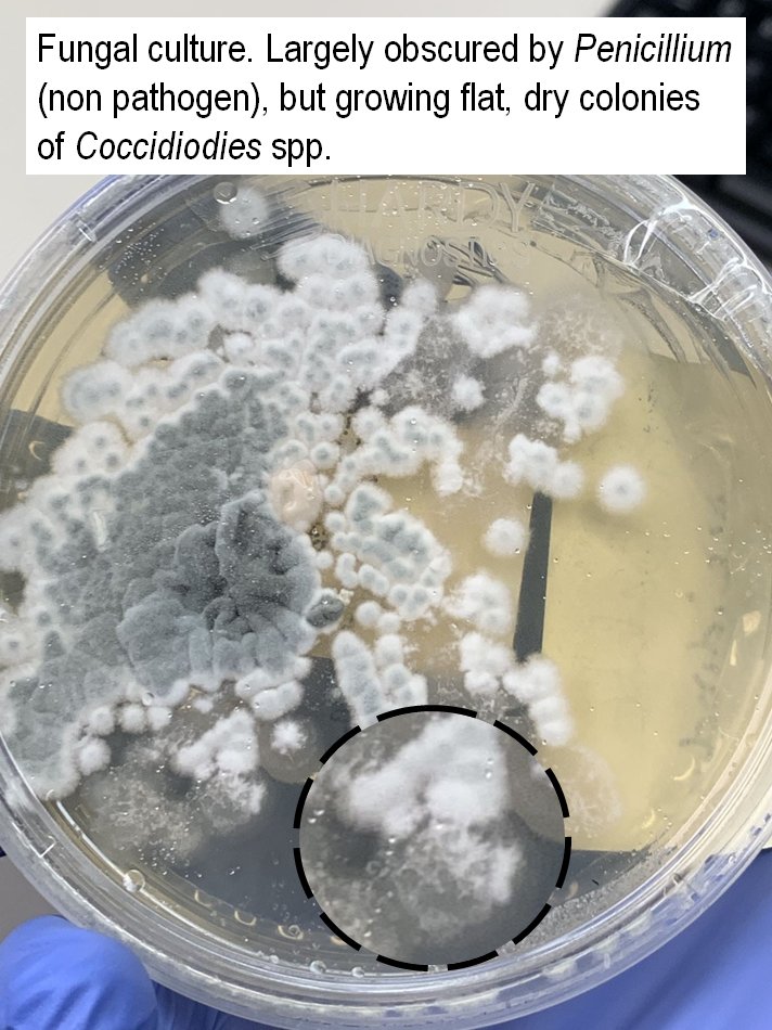 richdavisphd's tweet image. #MicroRounds (Day 843): For #LabWeek2021, I&apos;m highlighting #WhyClinMicroMatters with great catches by techs.

Fungal culture. Superficial source, lots of Penicillium. But suspicious tech looks behind it to find…

Coccidiodes spp.- a serious invasive mold #ASMClinMicro #IDTwitter