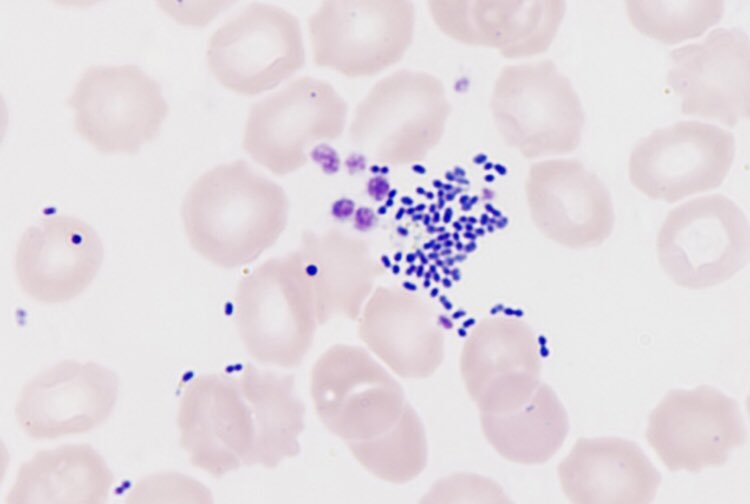 #idboardreview 70 M colon cancer presents w/ fever, chills, +murmur, new onset of heart failure, aortic valve vegetation. BC GPC. Dx? #idmedEd #medEd #idtwitter