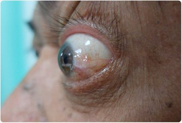 jullia_smith's tweet photo. What is Exophthalmos?. Click here for more knowledge :-https://t.co/UE6bKdJ8bF
eyes #surgery #Medical #doctors #Bulgingeyes #Cataract #Glaucoma #registration submit your paper #CallforPapers #earlybird :-https://t.co/zLXn6dCjBR https://t.co/RMonzqJfBx
