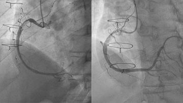 How should I treat residual large right coronary thrombus in a recent-healed #COVID19 patient with #STEMI? 

View part 1 of this case submitted by a team from 🇮🇹 and share how you would treat! 
ow.ly/3REk30rFd6w
#Cardiotwitter #CardioEd