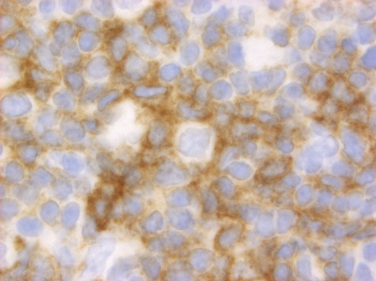 #hemepath PD1 in NLPHL. "A rose(tte) by any other name..."