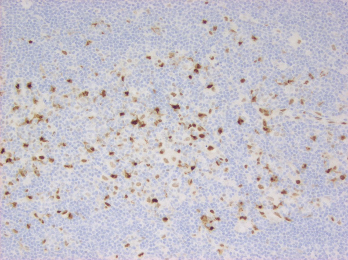 #hemepath cyclin D1 positive in LP cells of NLPHL