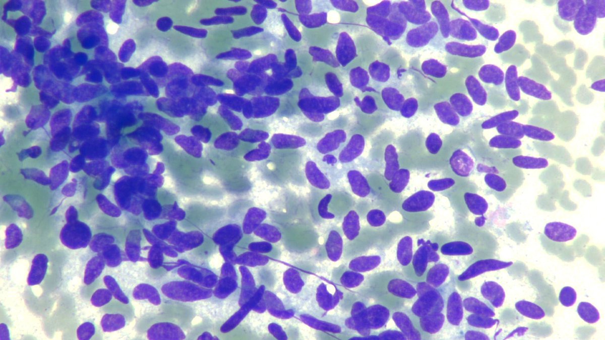 mdlozanoe's tweet image. Some examples of two members of the family of neuroendocrine lung tumors 
Top: carcinoid tumor.
Bottom: small cell carcinoma 
Not the same........ #cytopath #pathresidents