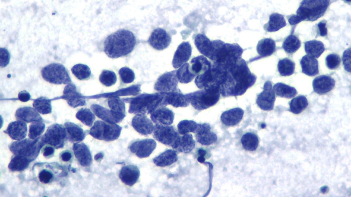 mdlozanoe's tweet image. Some examples of two members of the family of neuroendocrine lung tumors 
Top: carcinoid tumor.
Bottom: small cell carcinoma 
Not the same........ #cytopath #pathresidents