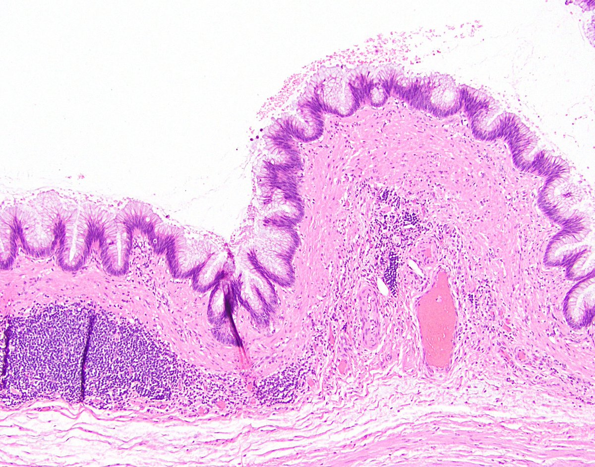 10/ 5. Undulating or flattened epithelial growth. This is basically always seen, as it’s how LAMNs typically look. The epithelial surface may be quite undulating or villiform (I’ve also seen it look serrated), or rather flat.