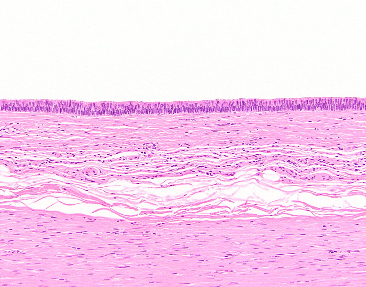 11/ Side note 2: As LAMNs are neoplasms, the epithelium is dysplastic by definition. It is of course low-grade, but sometimes it’s so bland (or so hidden by the intracellular mucin) that it looks like “no-grade” dysplasia.