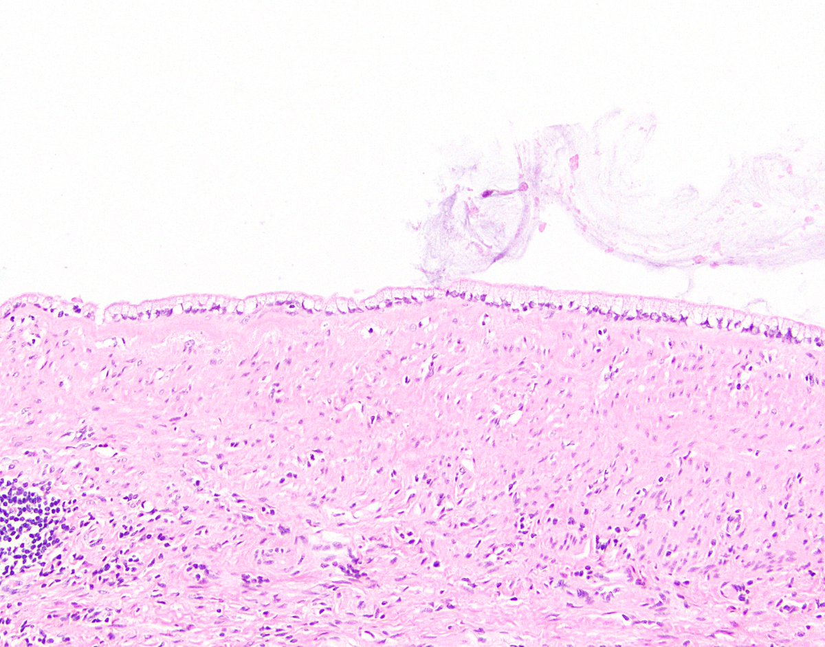 11/ Side note 2: As LAMNs are neoplasms, the epithelium is dysplastic by definition. It is of course low-grade, but sometimes it’s so bland (or so hidden by the intracellular mucin) that it looks like “no-grade” dysplasia.
