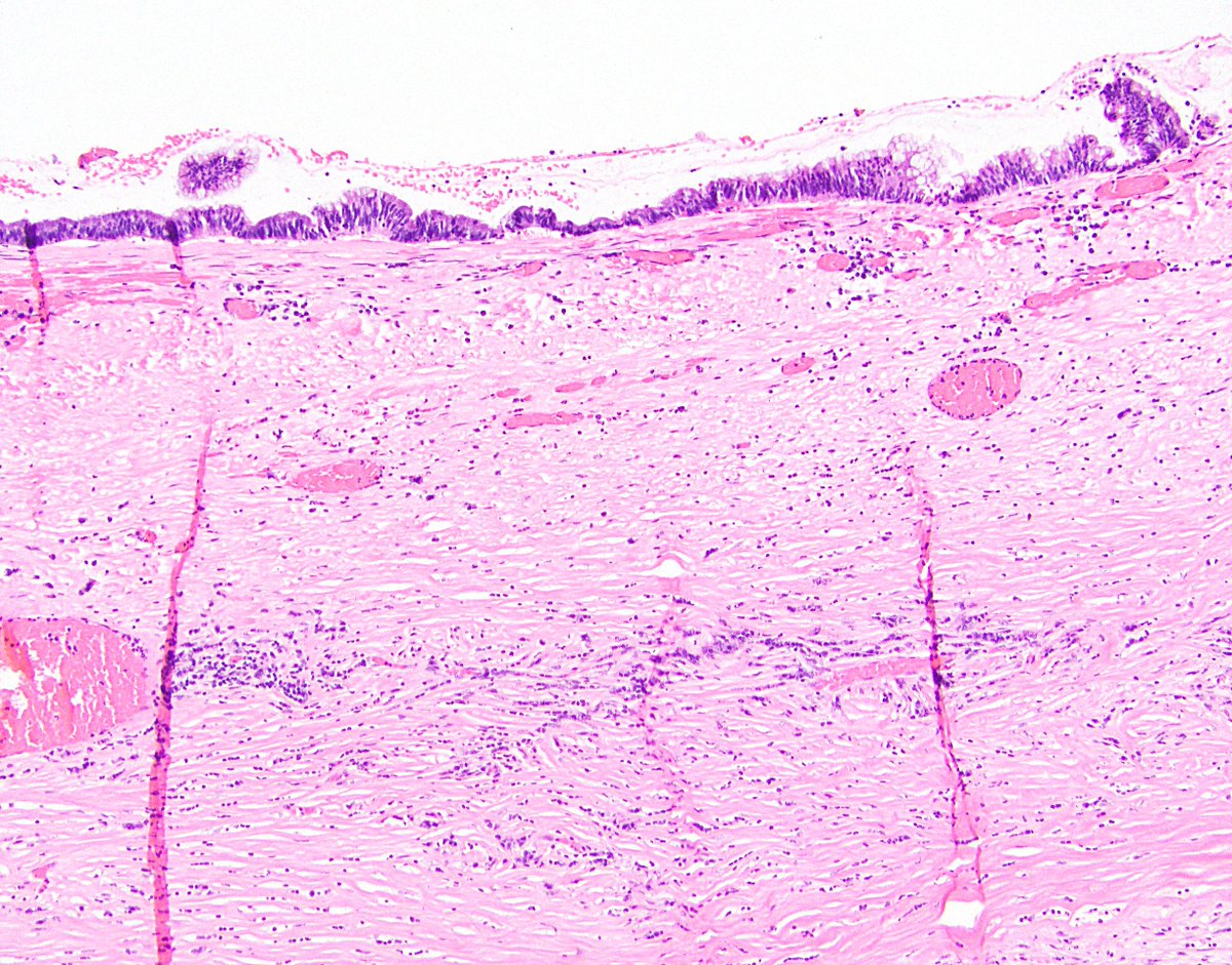 6/ 2. Fibrosis of submucosa. This is fairly common as well, and it can really distort the appendiceal architecture and make it difficult to determine how deep a LAMN goes. This can cause consternation when trying to stage a LAMN (discussed later).