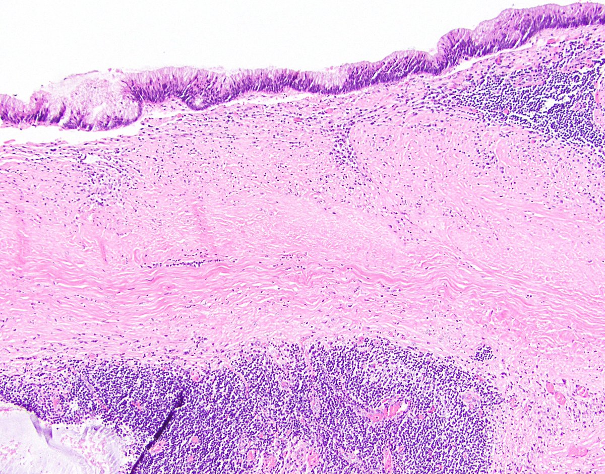 6/ 2. Fibrosis of submucosa. This is fairly common as well, and it can really distort the appendiceal architecture and make it difficult to determine how deep a LAMN goes. This can cause consternation when trying to stage a LAMN (discussed later).