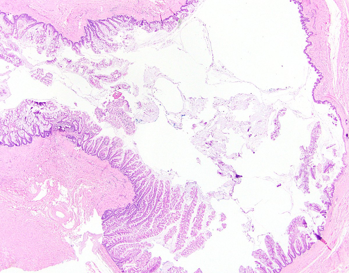 8/ Side note: LAMNs can involve diverticula, which are weak points that make it even easier for the neoplasm to make its way through the wall. The second photo is a nonneoplastic appendiceal diverticulum, just for reference. Ref:  https://bit.ly/387mSY7 