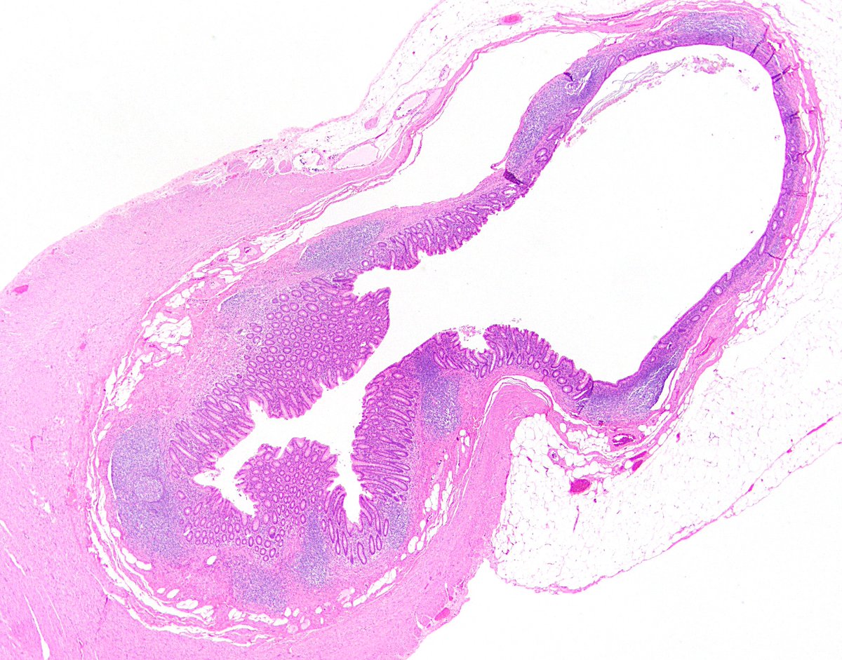 8/ Side note: LAMNs can involve diverticula, which are weak points that make it even easier for the neoplasm to make its way through the wall. The second photo is a nonneoplastic appendiceal diverticulum, just for reference. Ref:  https://bit.ly/387mSY7 