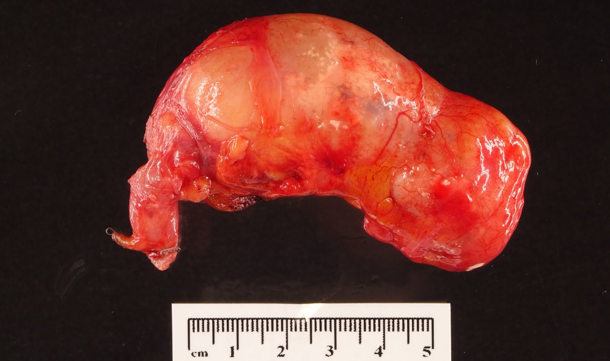 19/ Grossly, LAMN looks about how you’d expect -- namely, “gross.” Part or all of the appendix is dilated and filled with mucin (a mucocele).