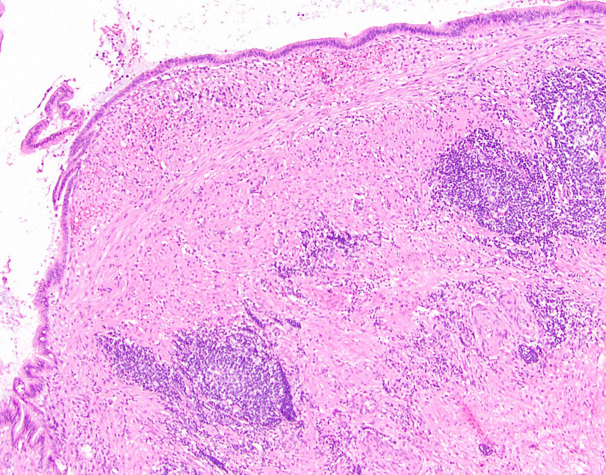 21/ I covered most of the histologic features of LAMN earlier, in definitional criteria. One additional important feature is that LAMN usually obliterates the lamina propria and the normal appendiceal crypts. If you see those, hesitate before calling it a LAMN!