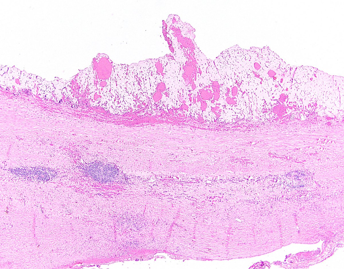 22/ Also, sometimes a “mucocele” will have a thin, fibrotic wall, mural calcifications, and/or a histiocytic reaction obliterating the epithelium. Look closely in your million sections -- these are almost always LAMN, and there should be scant residual epithelium somewhere.