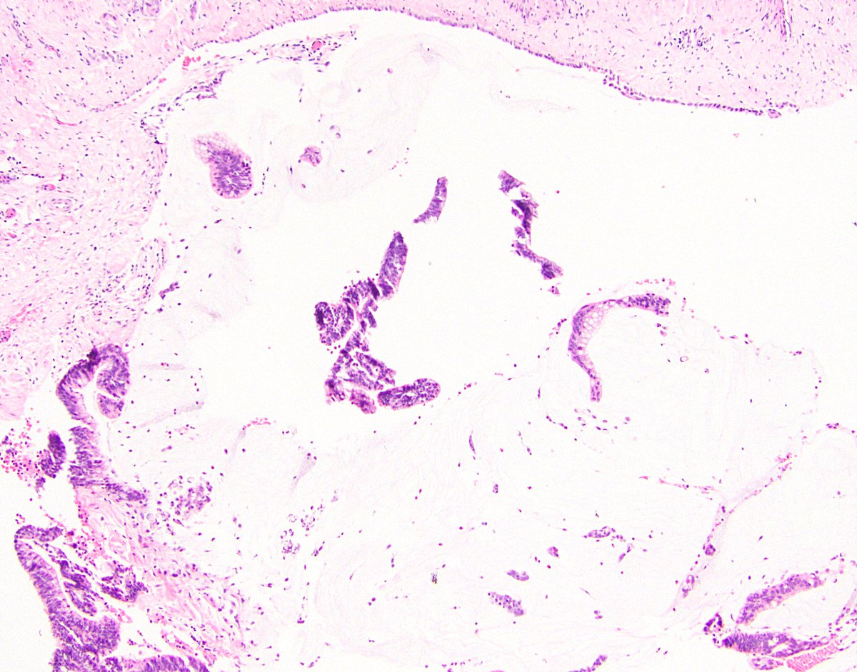 30/ pT4 is where things really start to get important. For LAMN, this means epithelium or mucin at/beyond the serosal surface. This usually means the appendix blatantly perforated, but sometimes the LAMN or the mucin can subtly squeeze through, so be alert and look carefully.