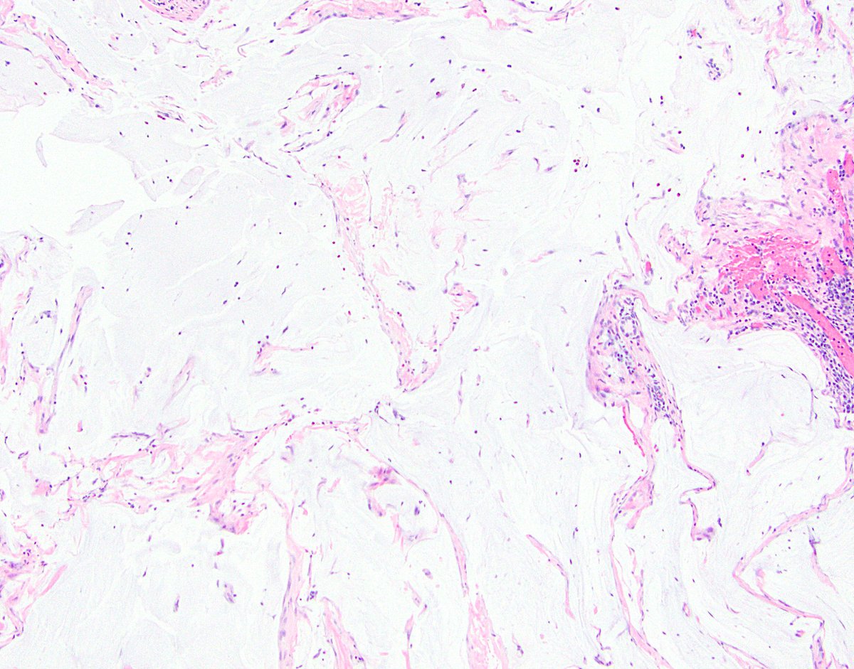 31/ Side note 5: If you’re wondering whether mucin made it beyond the serosa via perforation (in the patient, pic 1) or via knife carry-over (in the gross room, pic 2), look for inflammation and fibrovascular tissue in the mucin. If you see it, it’s likely true pT4.