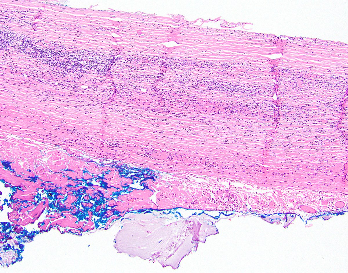 31/ Side note 5: If you’re wondering whether mucin made it beyond the serosa via perforation (in the patient, pic 1) or via knife carry-over (in the gross room, pic 2), look for inflammation and fibrovascular tissue in the mucin. If you see it, it’s likely true pT4.