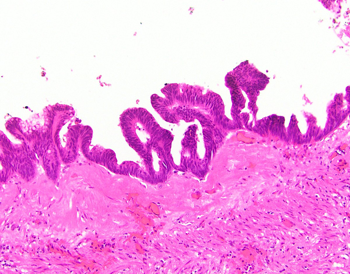 60/ 6th, HAMN. This rare, unsightly cousin to LAMN looks an awful lot like it at low power. By PSOGI criteria, if you’ve got something that fits LAMN criteria but has at least focal “unequivocal” high-grade dysplasia, it’s HAMN. It seems to behave the same biologically.