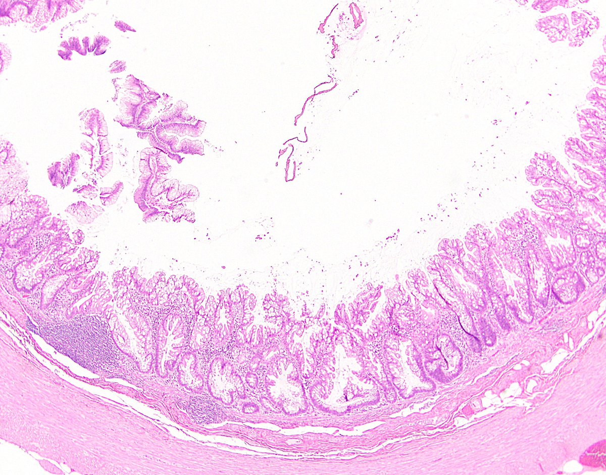56/ 3rd and sometimes trickiest, serrated polyp (per PSOGI; sessile serrated lesion per WHO). These look like their serrated cousins in the colon, with booting and etc. Often circumferential, may have cytologic dysplasia, usually plenty of lamina propria still.
