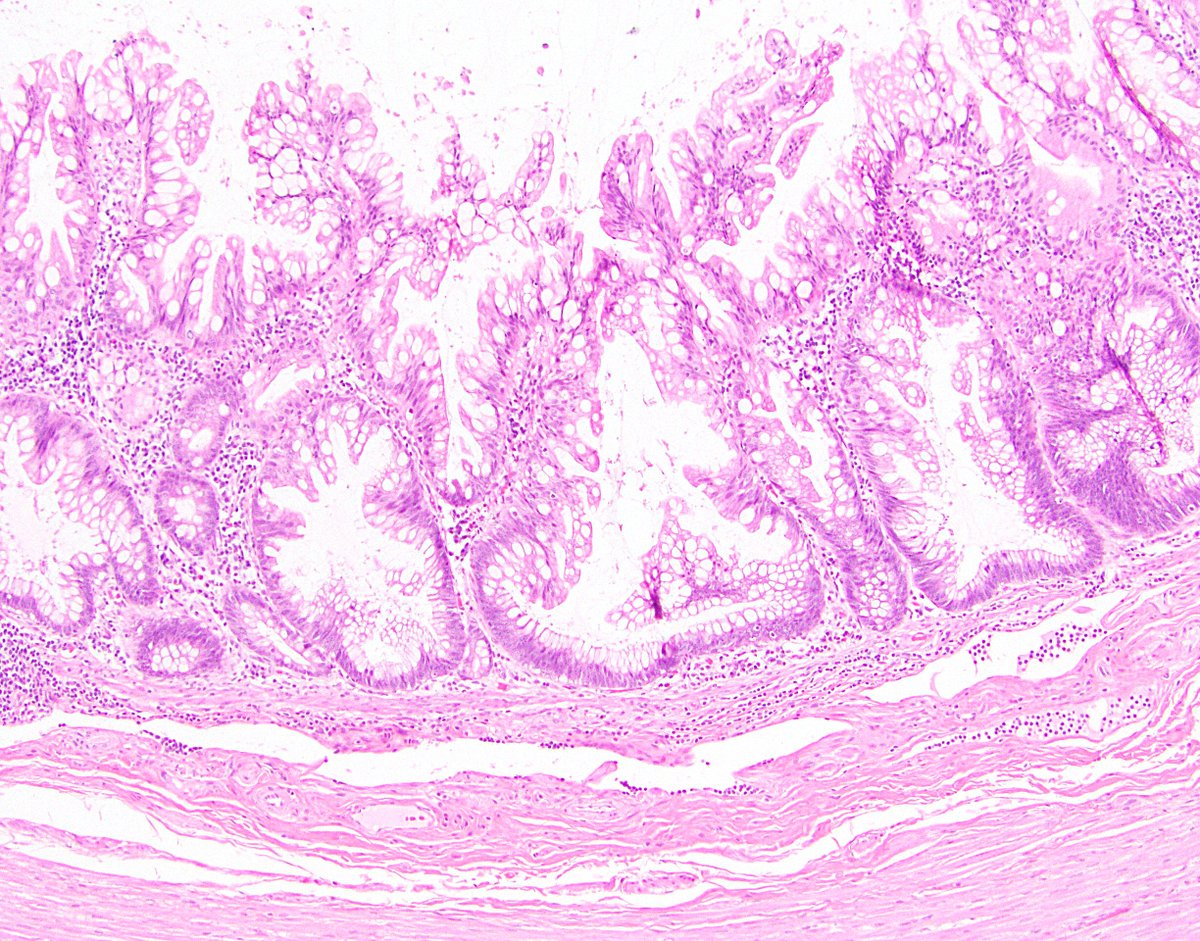 56/ 3rd and sometimes trickiest, serrated polyp (per PSOGI; sessile serrated lesion per WHO). These look like their serrated cousins in the colon, with booting and etc. Often circumferential, may have cytologic dysplasia, usually plenty of lamina propria still.