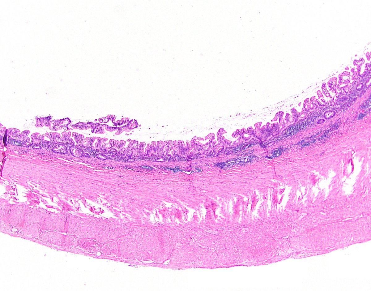 58/ 4th, traditional serrated adenoma. This guy, or a related lookalike, can pop up in the appendix, though it hasn’t been published on too much. More likely to be confused for a serrated polyp than a LAMN, but definitely in the differential. Ref:  https://bit.ly/3bgOOL8 