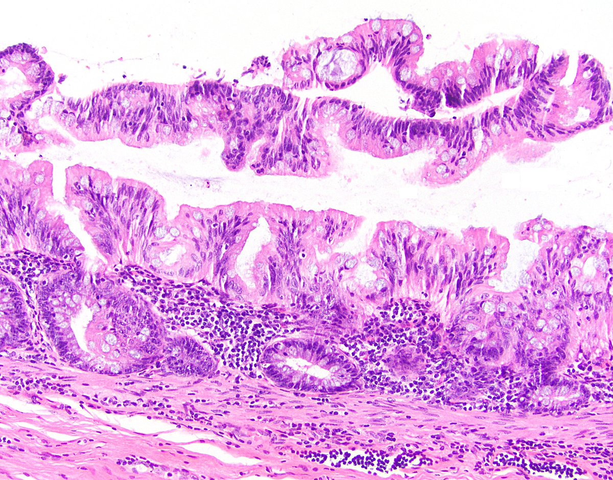 58/ 4th, traditional serrated adenoma. This guy, or a related lookalike, can pop up in the appendix, though it hasn’t been published on too much. More likely to be confused for a serrated polyp than a LAMN, but definitely in the differential. Ref:  https://bit.ly/3bgOOL8 