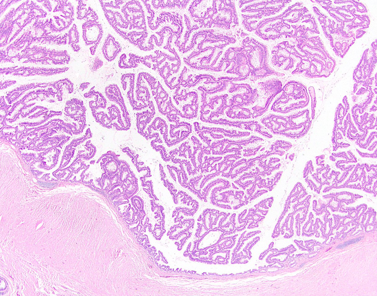 59/ 5th, tubulovillous adenoma. These can occur in the appendix, and they are often much more mucinous than their colorectal counterparts. If something seems too florid or cytologically striking to be a LAMN, consider TVA. Tubular adenomas are rare in the appendix outside FAP.
