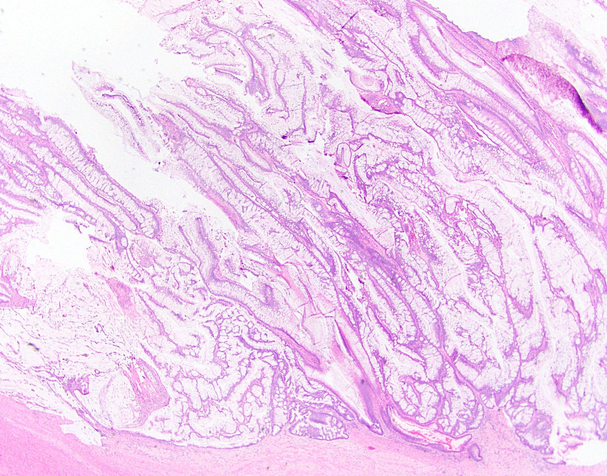 59/ 5th, tubulovillous adenoma. These can occur in the appendix, and they are often much more mucinous than their colorectal counterparts. If something seems too florid or cytologically striking to be a LAMN, consider TVA. Tubular adenomas are rare in the appendix outside FAP.