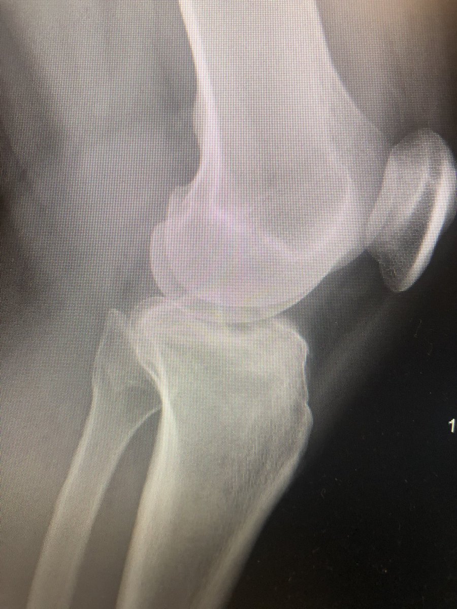 [1/6] Tibial plateau with eminence fracture. The Xrays show you the breaks in the plateau but also that the eminence seems odd somehow. This is more complex than it appears at first glance.