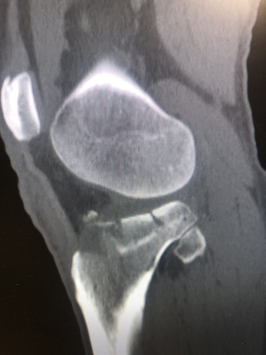 [2/6] CT gives you lots of info including comminution in the weightbearing lateral surface, and also the eminence fracture (arrow). Because of how medial this was, I planned for a femoral distractor. Make sure to limit your distraction time due to risk to peroneal nerve.