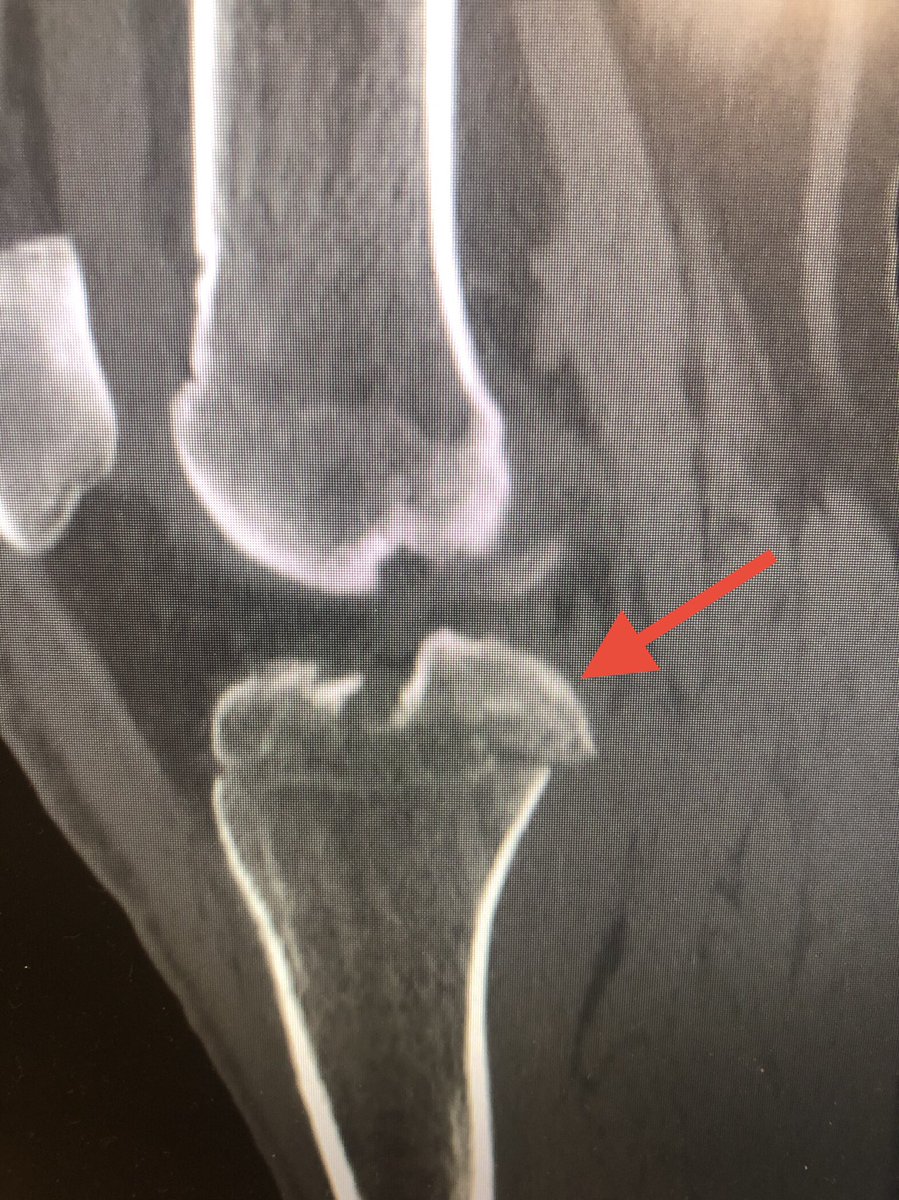 [2/6] CT gives you lots of info including comminution in the weightbearing lateral surface, and also the eminence fracture (arrow). Because of how medial this was, I planned for a femoral distractor. Make sure to limit your distraction time due to risk to peroneal nerve.