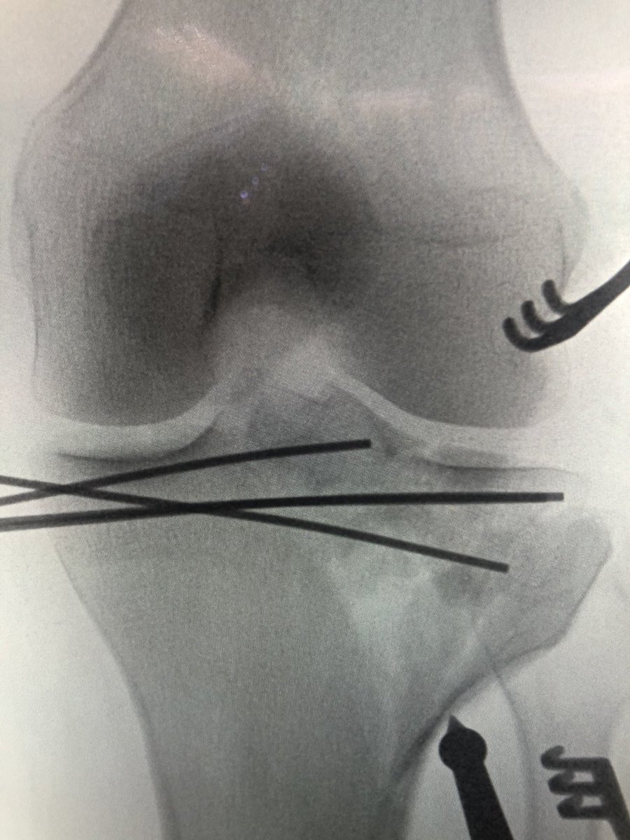 [3/6] Once joint was distracted, I could see the eminence and maneuver it enough to k wire it to a reasonable reduction. I then brought the wire out the medial side and withdrew it so it sat flush to the eminence. Then I began lateral side reconstruction.