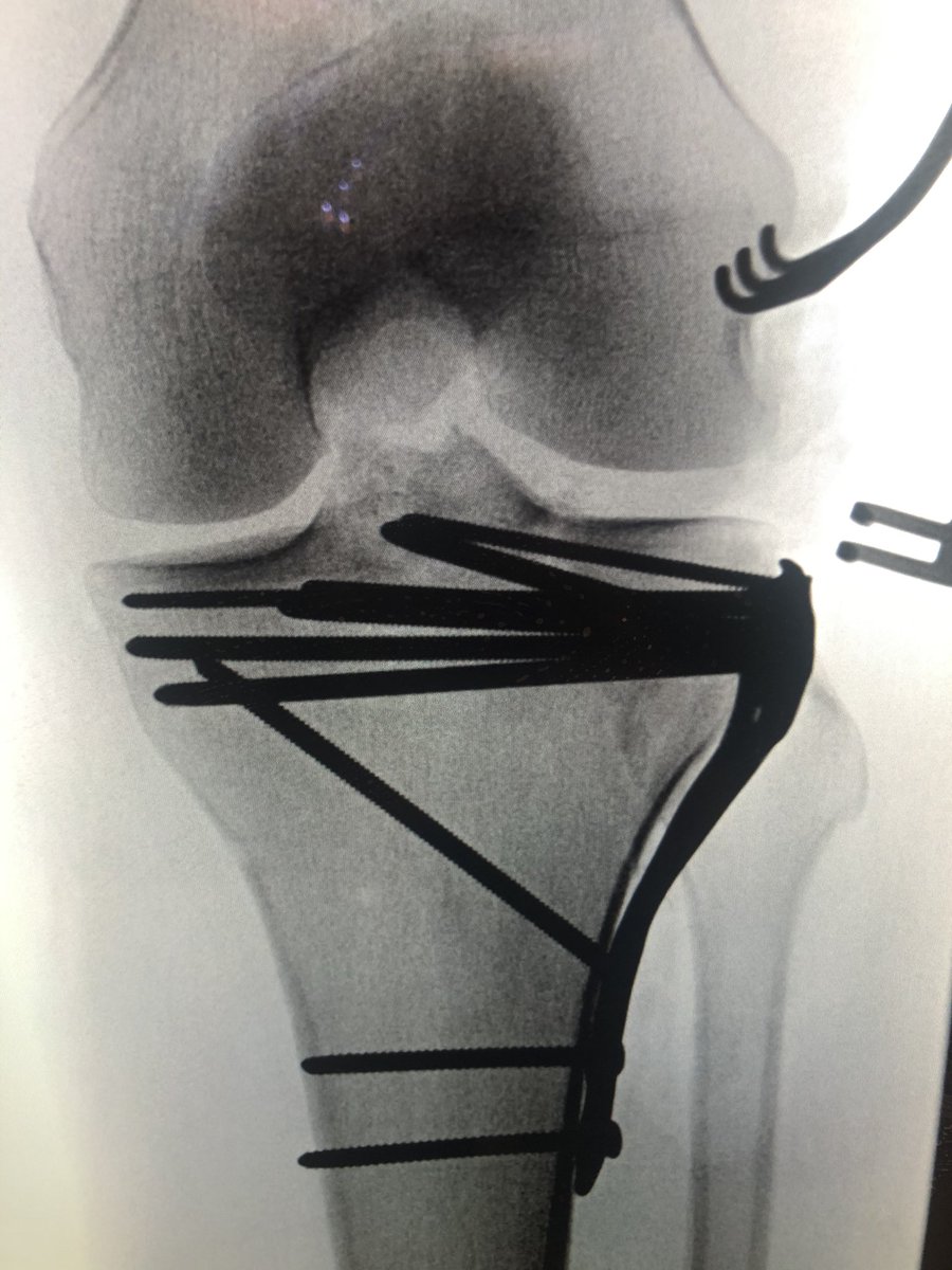 [5/6] This plate has small screws in proximal row, and I placed it more distally than usual so I could angle the little screws toward the eminence as best I could, without entering the joint. These screws also rafted the articular surface. The distractor was off at this point.