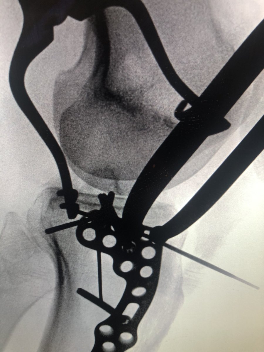 [5/6] This plate has small screws in proximal row, and I placed it more distally than usual so I could angle the little screws toward the eminence as best I could, without entering the joint. These screws also rafted the articular surface. The distractor was off at this point.