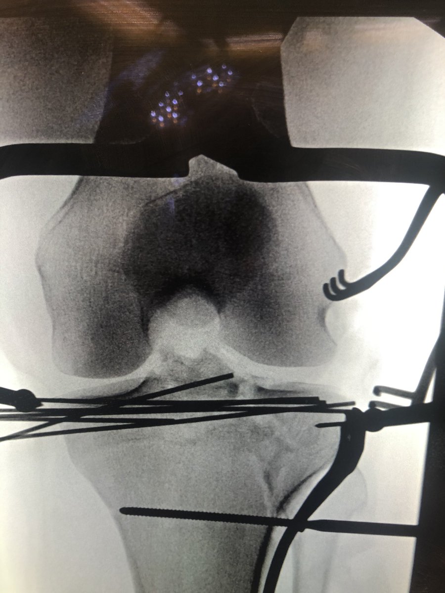 [4/6] Like most of my complex plateaus this one ended up a “porcupine” of K wires. Once I brought the lateral side up, I backfilled with allograft in metaphysis. To compress everything I used a periarticular clamp, withdrawing and changing wires if reduction kicked out.