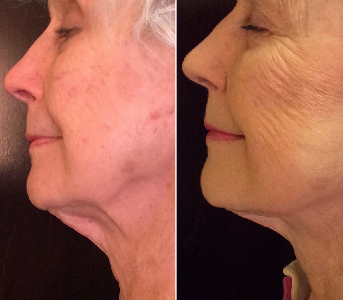 spa35Boise's tweet photo. It’s a beautiful day to build some elastin and collagen with a Profound lift! FREE CO2 laser when you purchase a Profound Lift this month.

Phone ☎️ (208) 367-0700
Website 🖥 https://t.co/QJIqd1QrS9

#spa35 #boisebestmedspa #beautifulskin #profoundrf #candela #latisse #obagi https://t.co/zaefEJKW0a
