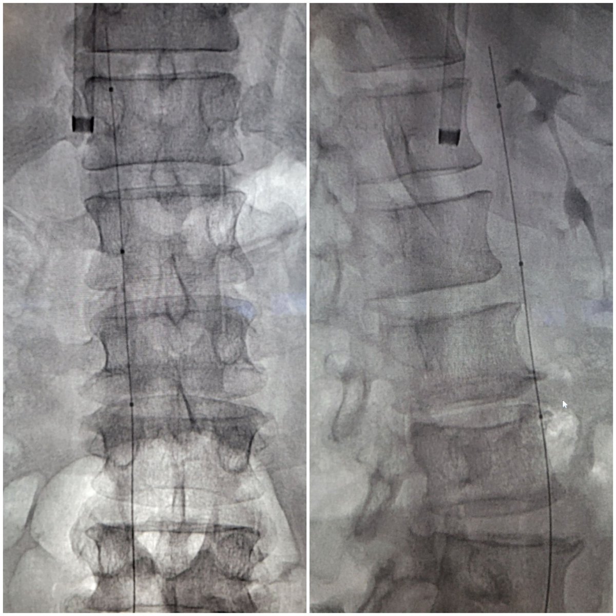 TempleRADs's tweet photo. Patient with filter and chronic IVC thrombosis. Filter removed with forceps. Drilled through occlusion and laid down stents with IVUS. What a beautiful result! Like a work of art. Nice job @Nmontec2 Joseph Panaro MD. @TempleRadRes @SIRRFS @SIR_ECS  @SIRspecialists #IRAD https://t.co/D0TgtbtWle