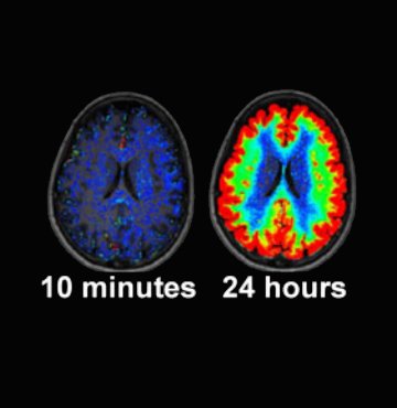 Matt Walkerさんのツイート A Night Without Sleep Impairs Clearance Of Molecular Detritus Within The Human Brain This Was Not Compensated For By A Recovery Night Of Sleep Editorial Note Suggests That In This