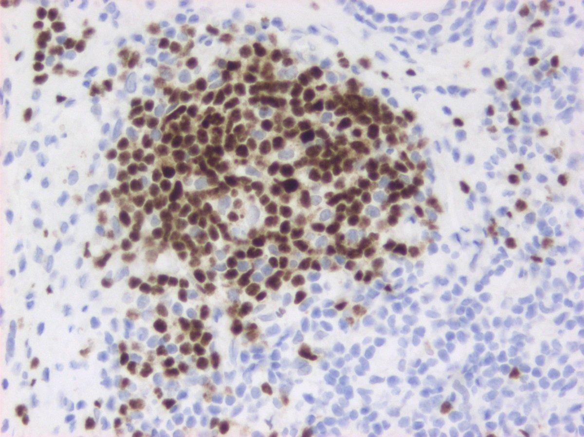 #Hemepath PAX8 staining in B cells. It happens. 🙄