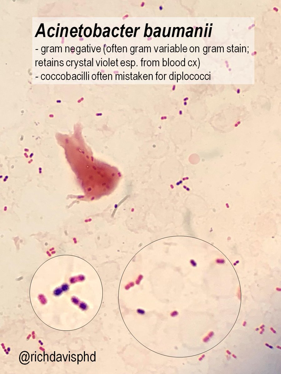 richdavisphd's tweet image. #MicroRounds (Day 844): For #LabWeek2021, #WhyClinMicroMatters with a great catch by a clinical microbiologist:

Gram stain looks mixed, with diff shapes, stains. But it&apos;s NOT!

Acinetobacter baumannii (&quot;A-bomb&quot;) is G(-) but retains the stain, can look G+ #ASMClinMicro #IDTwitter