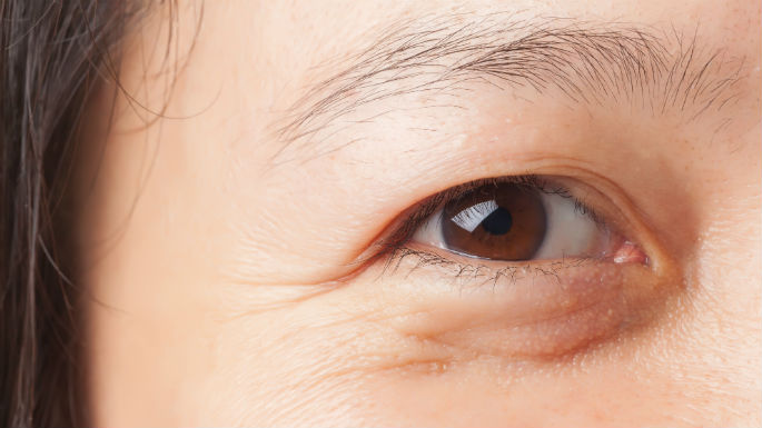 MedicalNE's tweet photo. What Causes Bags Under the Eyes? Bags under the eyes are unsightly… #Acton #Fitchburg https://t.co/9tg5ohWKTP https://t.co/sfRjBWFrc3