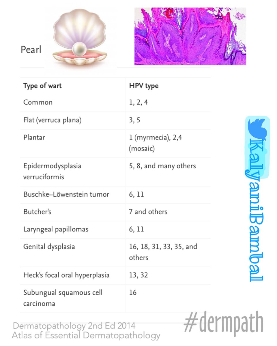 kriyer68's tweet photo. HPV types associated with different warty lesions.
#residents #pathpearls
#pathboards #dermpath 
@HENRYY_MD @redsnapperpath @VijayPatho @junu_devi @PIorfino @mvmd0908 @Dermpathl @DraEosina @gonzadetoro @MAHoureih @eimanhasby 
@david_terrano @anjuthevirgo https://t.co/Ns8PB4BiDH