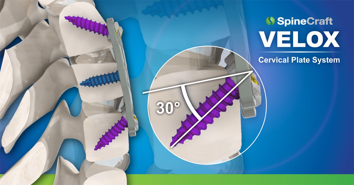SpineCraft VELOX AC Plate System. Maximize your fixation with screw angulation up to 30 degrees. Contact SpineCraft for more information: spinecraft.com/contact-us.html #spinesurgeon #spinesurgery #spinesurgeons